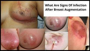 What Are Signs Of Infection After Breast Augmentation