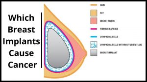 Which Breast Implants Cause Cancer