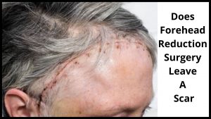Does Forehead Reduction Surgery Leave A Scar