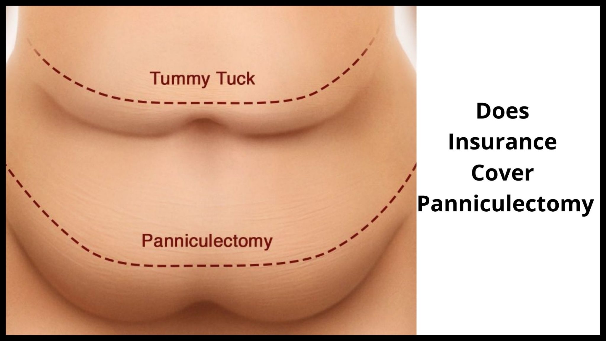 Can A Tummy Tuck Be Covered By Insurance? Facts you must KNOW!