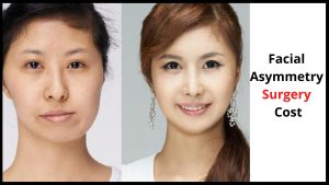 Facial Asymmetry Surgery Cost