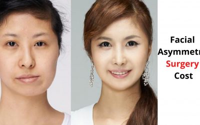 Facial Asymmetry Surgery Cost – Cost breakdown and Details!