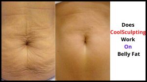 Does CoolSculpting Work On Belly Fat