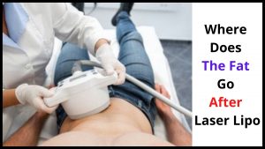 Where Does The Fat Go After Laser Lipo