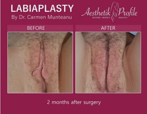 labiaplasty after 4 weeks
