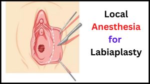 Local Anesthesia for Labiaplasty