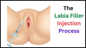 The Labia Filler Injection Process